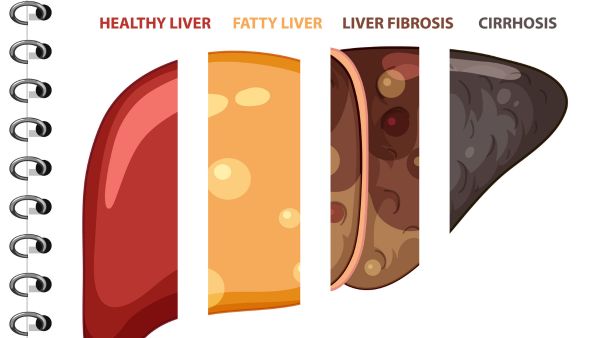 Fatty Liver Disease Risks