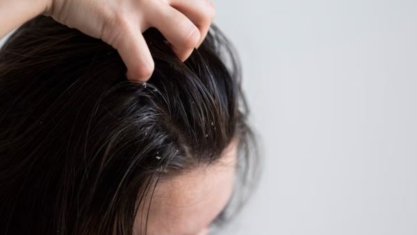 Dandruff Treatment for Thin Hair