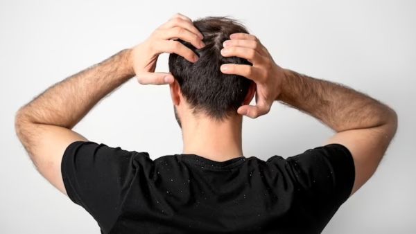 Dandruff Treatment for Thin Hair
