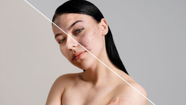 Products To Include In Acne Skincare