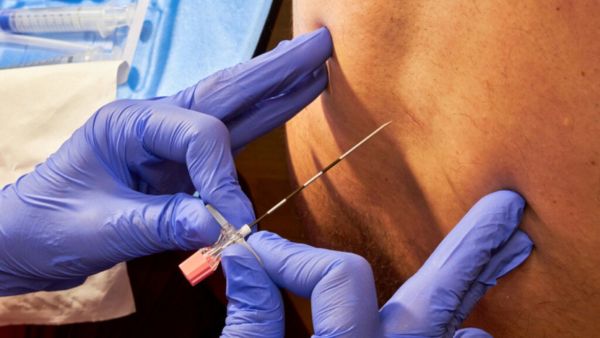 Are Epidurals Painful?