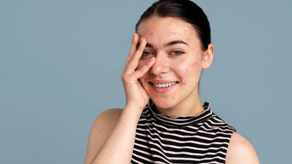 How To Hide Pimples And Acne?