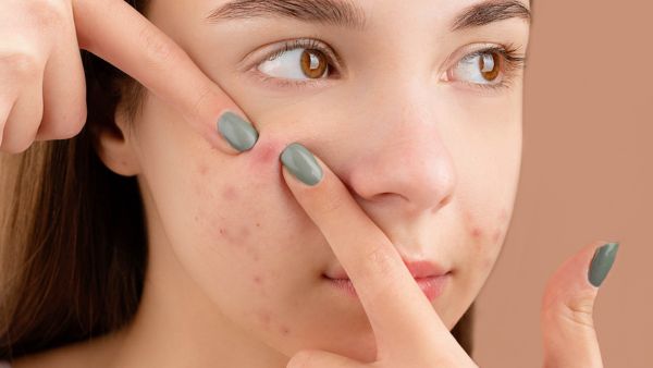 Remedy To Get Rid Of Pimple Marks Remedy To Get Rid Of Pimple Marks