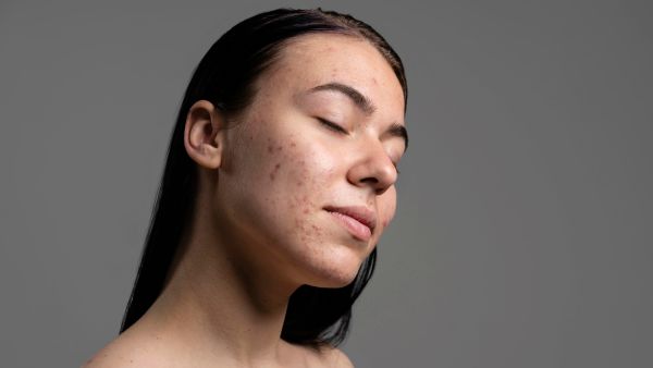 Beauty Problems Caused By Vitamin D Lack