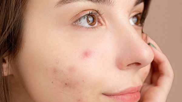 Medical Treatment For Acne And Pimples