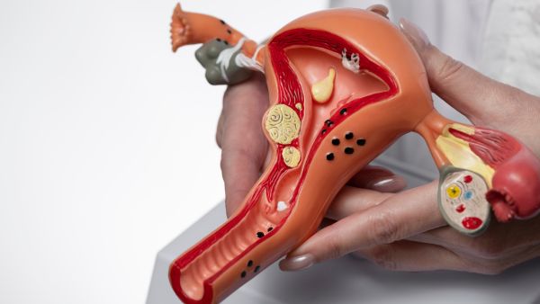 What Is PCOD? Causes And Signs