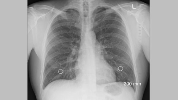 What Is White Lung Syndrome? 