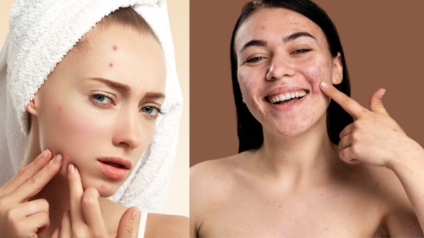 Why Cant We Resist Popping Pimples? Lets Find Out Why We Derive So Much Pleasure From It! Why Cant We Resist Popping Pimples? Lets Find Out Why We Derive So Much Pleasure From It!