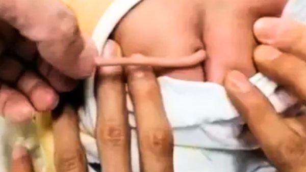 In China Infant Is Born With Four-Inch Tail Growing from Its Buttocks Know The Reason Behind This