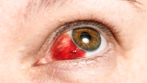 A 74-year-Old Man Bleeds From Eyes And Dies Due To A Rare Ebola-Like Virus In Spain All You Need To Know