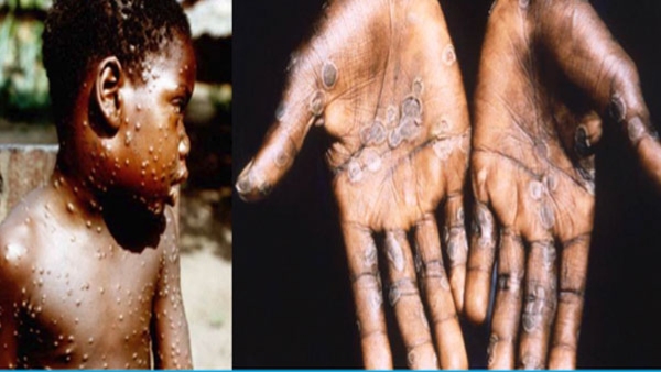 WHO Declares Monkeypox Outbreak Health Emergency Only These Vaccines Are Approved For The Treatment