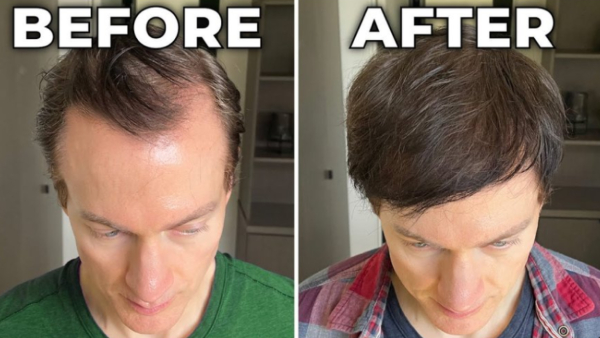 Biohacker Reverses Hair Loss amp amp Greying