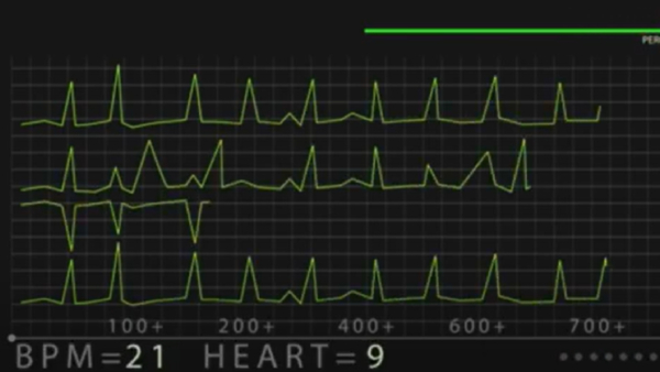 The Heart Failure Predictor