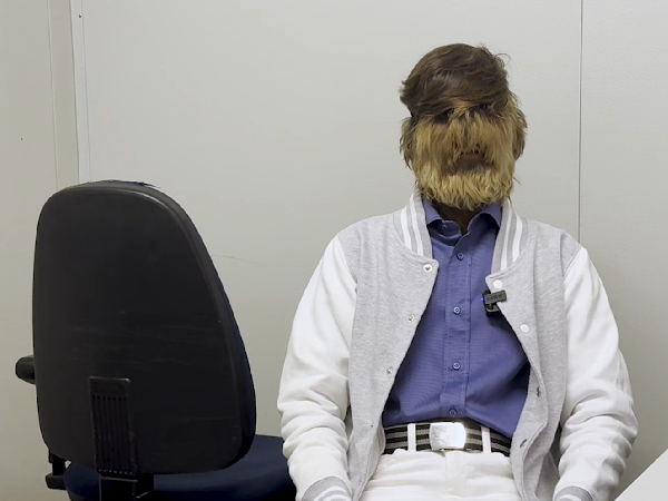 Boy Breaks Records With Hypertrichosis