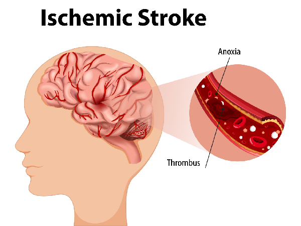 Silent Stroke Risk Carotid Artery Block Silent Stroke Risk Carotid Artery Block