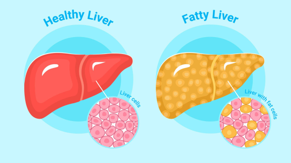 Tech Toxins And Takeout Dietitian Reveals How Modern Lifestyle Is Slowly Killing Your Liver Tech Toxins And Takeout Dietitian Reveals How Modern Lifestyle Is Slowly Killing Your Liver