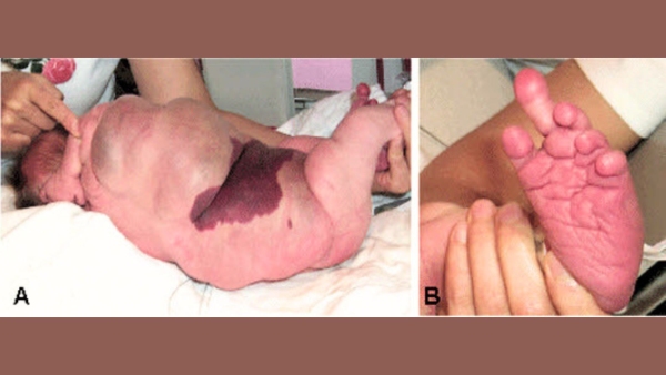 Cloves Syndrome Awareness Day 2025 Is Your Child s Overgrowth More Than Just Genetics Know The Signs Cloves Syndrome Awareness Day 2025 Is Your Child s Overgrowth More Than Just Genetics Know The Signs