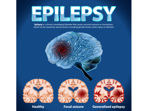 Epilepsy Stigma No One Talks About