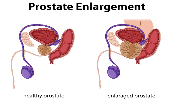 Prostate-cancer