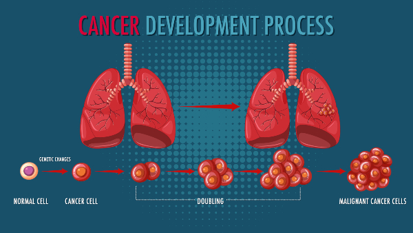 lunger-cancer-development-process lunger-cancer-development-process