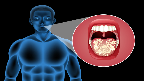 oral-cancer oral-cancer