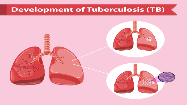 development-of-TB