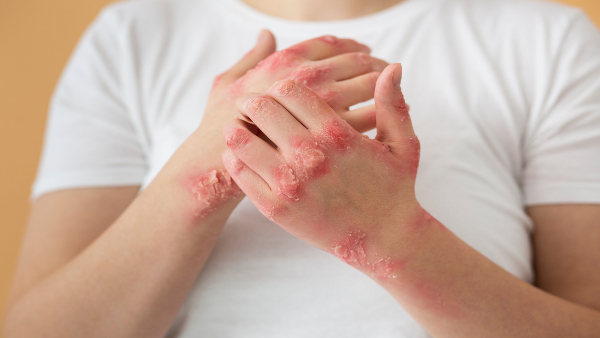 hands-patient-suffering-from-psoriasis