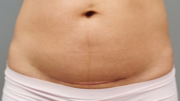 C-section-delivery C-section-delivery