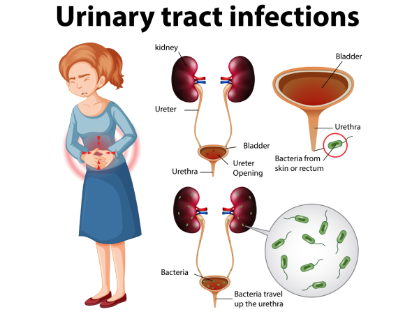 Why UTIs Rise In Summer