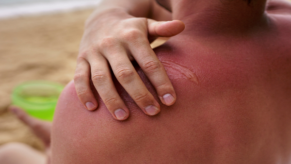 heat-rash heat-rash