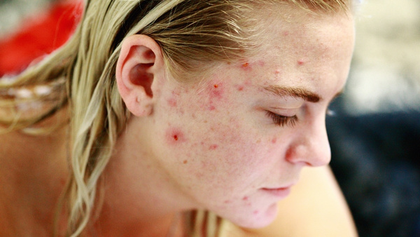 red inflamed acne red inflamed acne