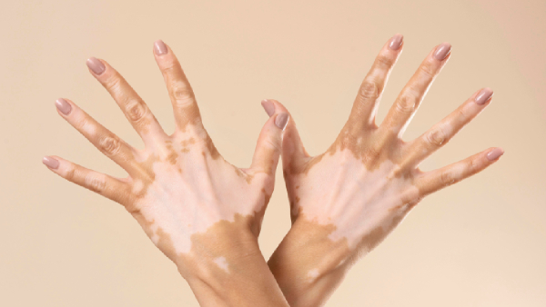 World Vitiligo Day 2026