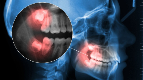 myths-and-facts-about-wisdom-teeth myths-and-facts-about-wisdom-teeth