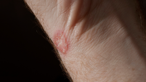 ringworm ringworm