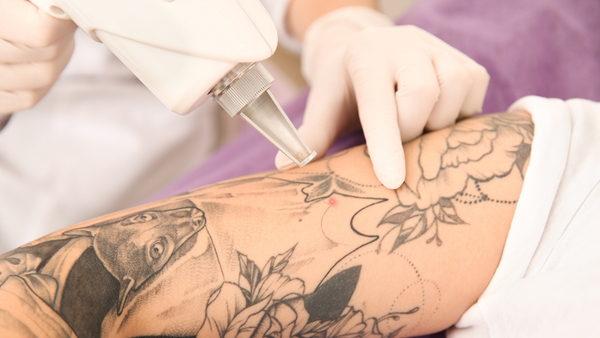 tattoo-removal tattoo-removal