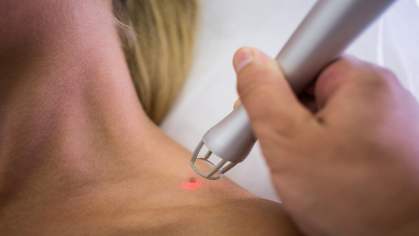 tattoo-removal-laser tattoo-removal-laser