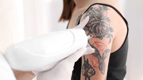tattoo-removal tattoo-removal