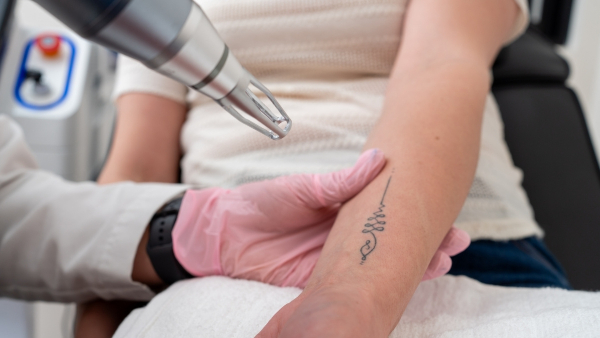 things-to-know-before-tattoo-removal things-to-know-before-tattoo-removal