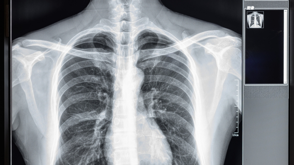 chest-CT-scan