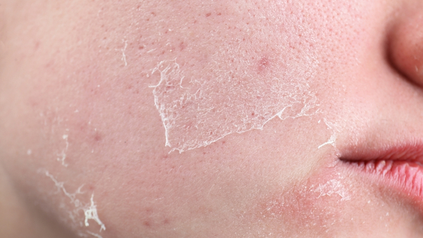 dry-skin