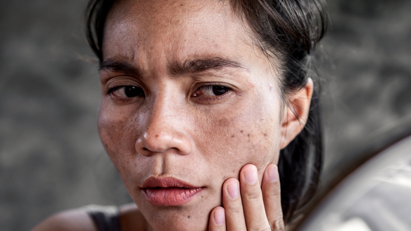 melasma-during-pregnancy melasma-during-pregnancy