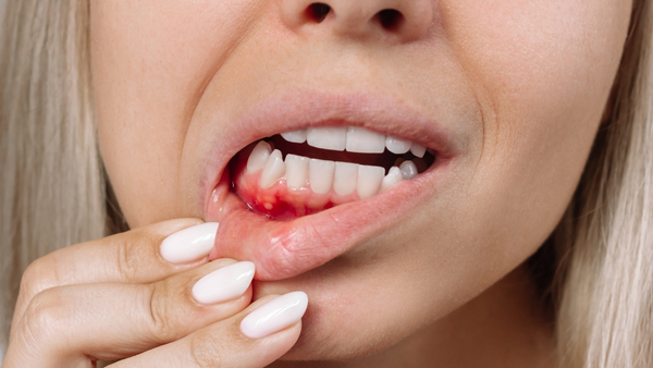 mouth ulcer mouth ulcer