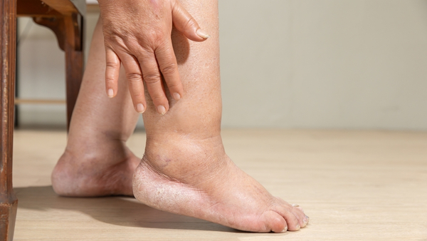 sarcoma swelling sarcoma swelling