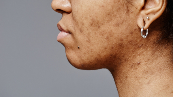 sun-pigmentation sun-pigmentation