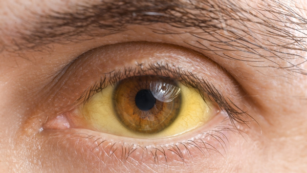 yellowing-of-eyes yellowing-of-eyes