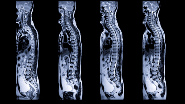 back-pain-MRI