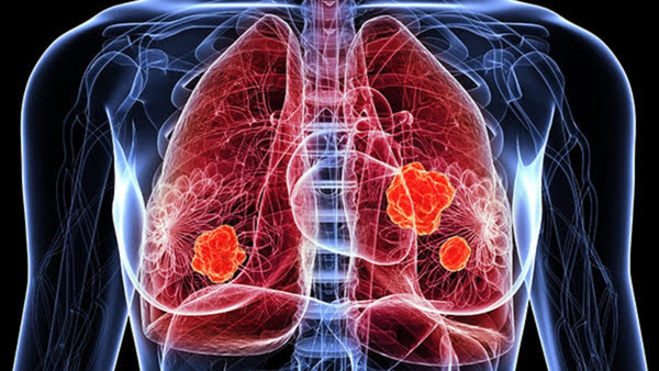lung-disease-polluted-city lung-disease-polluted-city