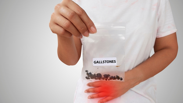gallstones gallstones