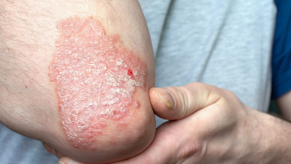 itching-in-psoriasis itching-in-psoriasis