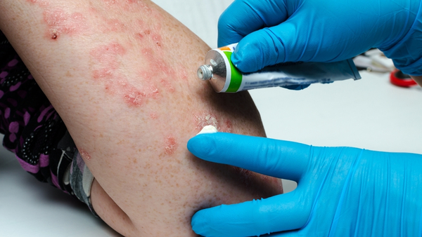 psoriasis-ointment psoriasis-ointment